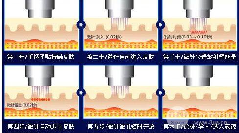 黄金微针