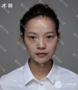 脸部黄褐斑如何基本缓解？会反弹吗？