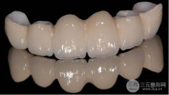 烤瓷牙有哪些种类？寿命是多少年？