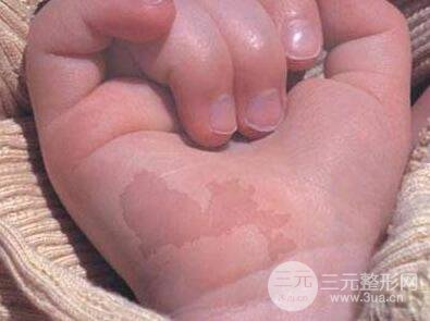 婴儿咖啡斑