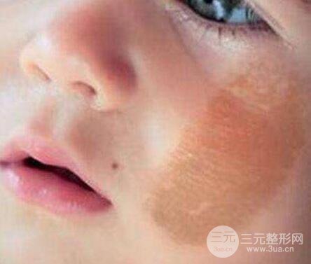 婴儿咖啡斑
