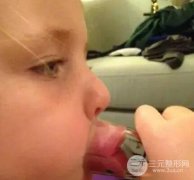 玻尿酸打嘟嘟唇缓解过程图片及恢复果 玻尿酸打嘟嘟唇缓解过程图片及恢复果