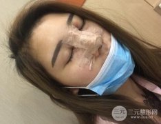 隆鼻假体能保持一辈子吗?耳软骨垫鼻尖永.久吗? 隆鼻假体能保持一辈子吗?耳软骨垫鼻尖永.久吗?