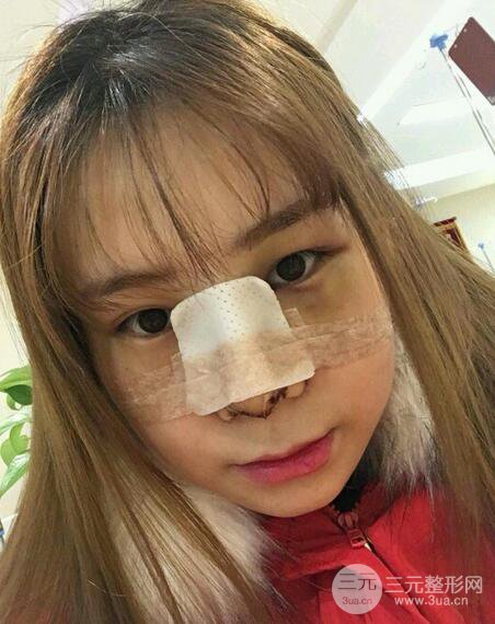 隆鼻整形术前术后对比照|术后恢复阶段性跟踪分享