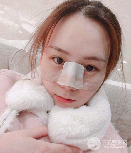 隆鼻整形术前术后对比照|术后恢复阶段性跟踪分享