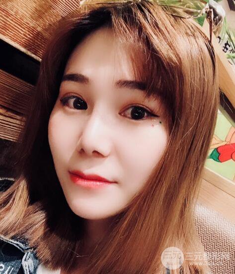 隆鼻整形术前术后对比照|术后恢复阶段性跟踪分享