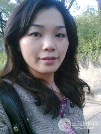 辛敏强隆鼻整形真实案例果对比照片分享