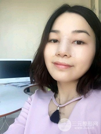 辛敏强隆鼻整形真实案例果对比照片分享