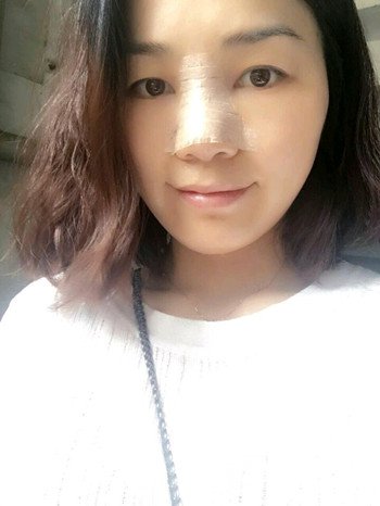 辛敏强隆鼻整形真实案例果对比照片分享