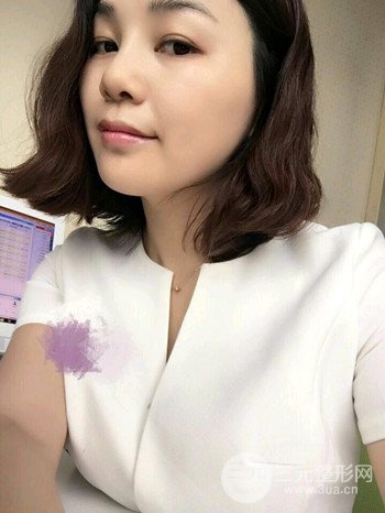 辛敏强隆鼻整形真实案例果对比照片分享