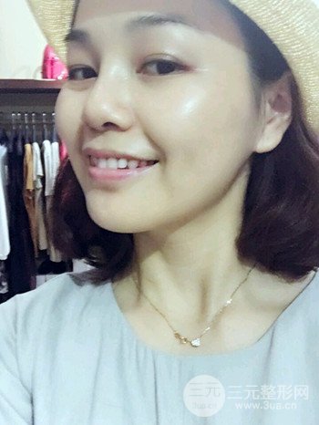 辛敏强隆鼻整形真实案例果对比照片分享