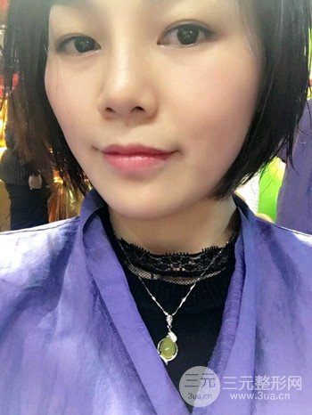 辛敏强隆鼻整形真实案例果对比照片分享