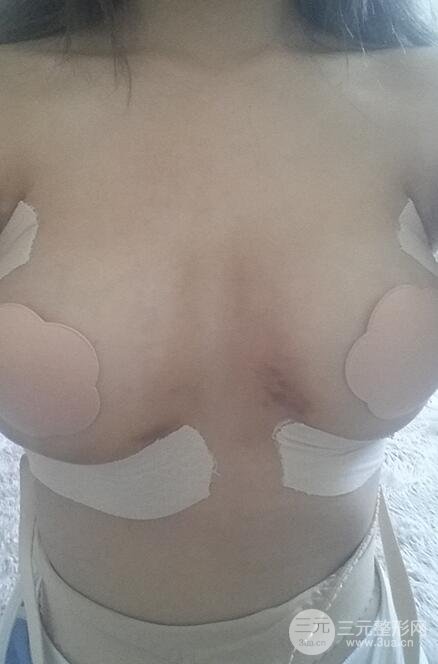 广东省第二人民医院罗盛康假体隆胸前后对比案例