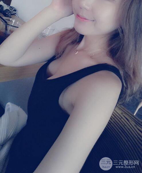 广东省第二人民医院罗盛康假体隆胸前后对比案例