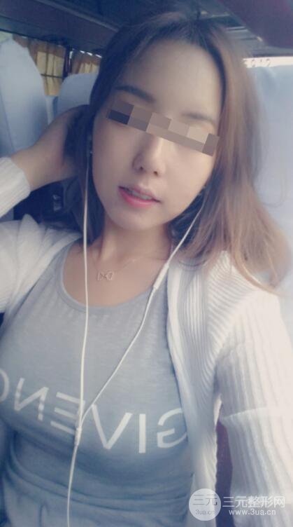 广东省第二人民医院罗盛康假体隆胸前后对比案例