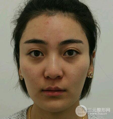 自体脂肪填充详细部过程分享|不用磨骨也可以小脸