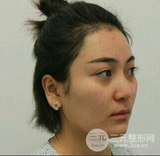 自体脂肪填充详细部过程分享|不用磨骨也可以小脸
