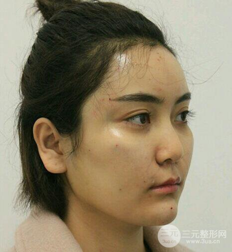 自体脂肪填充详细部过程分享|不用磨骨也可以小脸