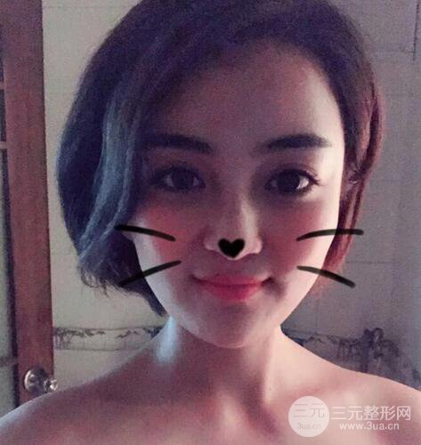 自体脂肪填充详细部过程分享|不用磨骨也可以小脸