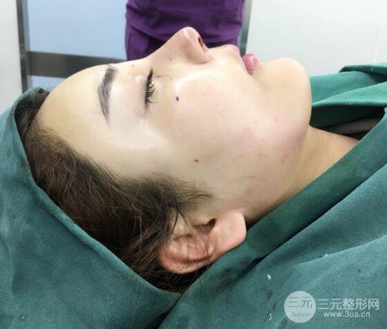 自体脂肪填充详细部过程分享|不用磨骨也可以小脸