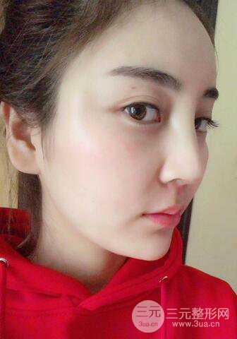 自体脂肪填充详细部过程分享|不用磨骨也可以小脸