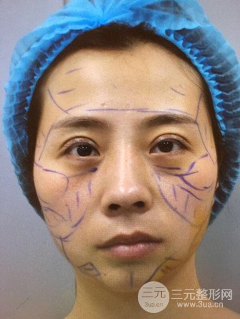 王克明全脸自体脂肪填充恢复果图|手术案例分享