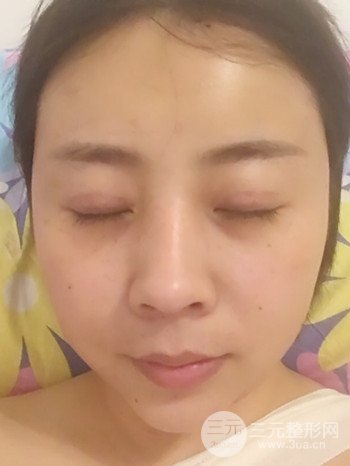 王克明全脸自体脂肪填充恢复果图|手术案例分享