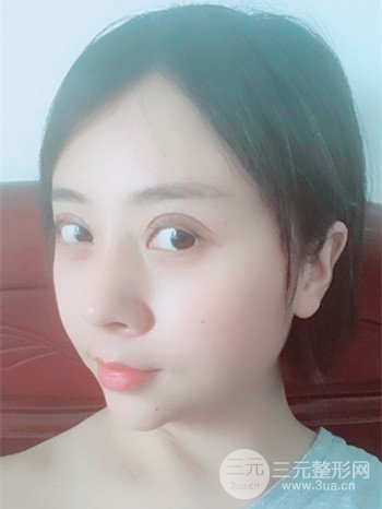 王克明全脸自体脂肪填充恢复果图|手术案例分享