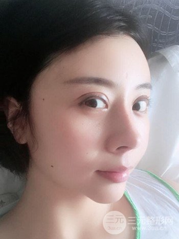 王克明全脸自体脂肪填充恢复果图|手术案例分享