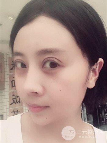 王克明全脸自体脂肪填充恢复果图|手术案例分享