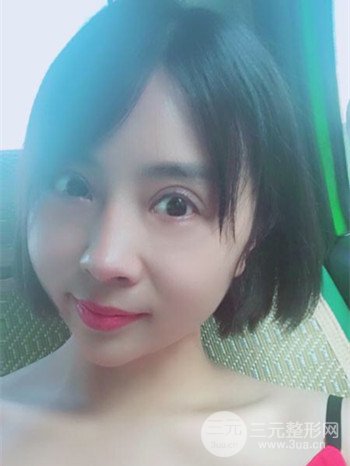 王克明全脸自体脂肪填充恢复果图|手术案例分享