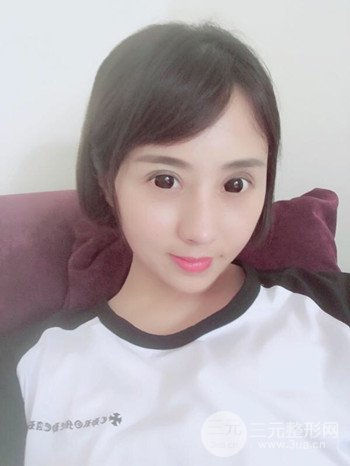 王克明全脸自体脂肪填充恢复果图|手术案例分享