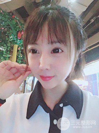 王克明全脸自体脂肪填充恢复果图|手术案例分享