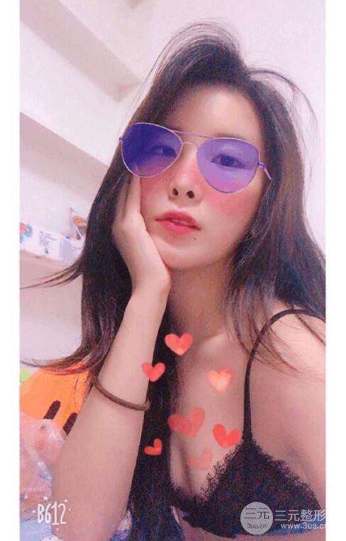 自体脂肪面部填充案例