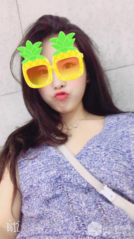 自体脂肪面部填充案例