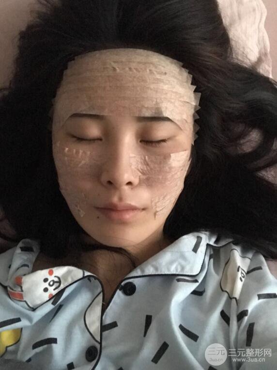 自体脂肪面部填充案例