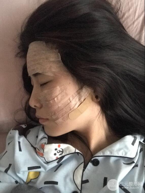 自体脂肪面部填充案例
