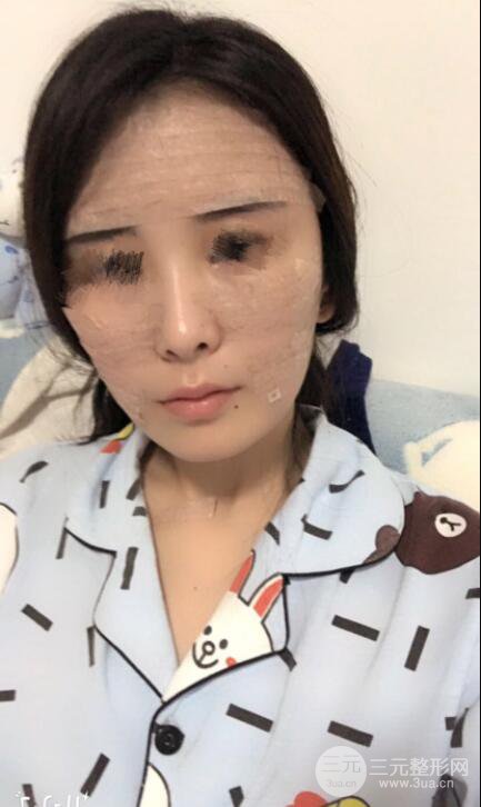 自体脂肪面部填充案例