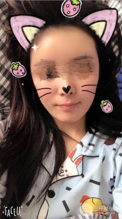 自体脂肪面部填充案例