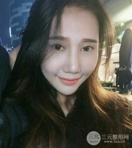 切开双眼皮前后对比图及恢复过程展示