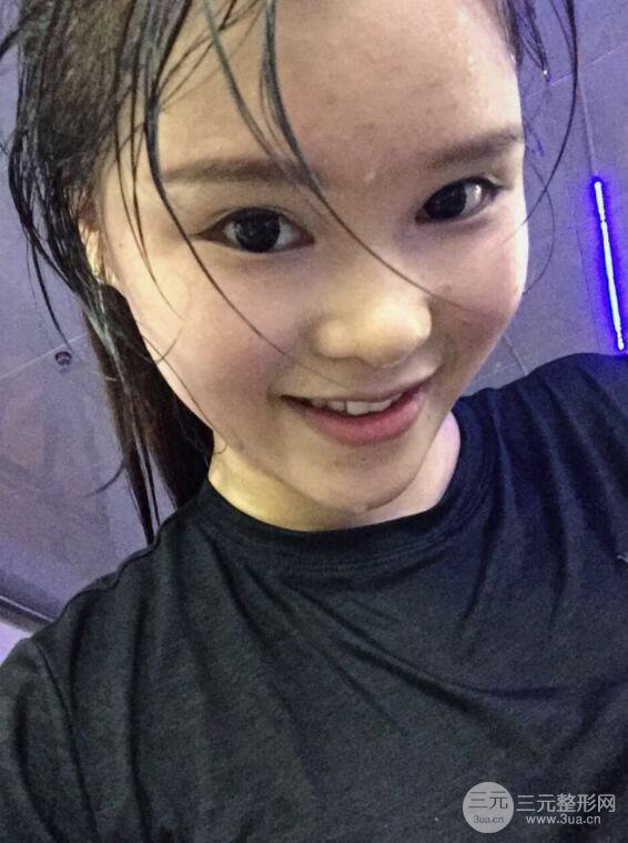 北京叶子整形鲁礼新隆鼻整形案例