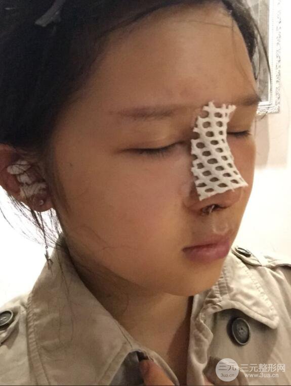 北京叶子整形鲁礼新隆鼻整形案例