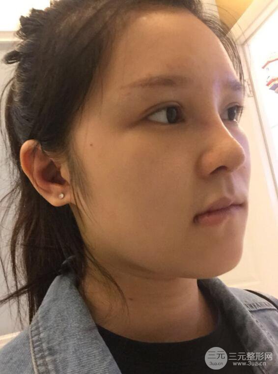 北京叶子整形鲁礼新隆鼻整形案例