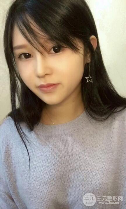 北京叶子整形鲁礼新隆鼻整形案例