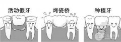 烤瓷牙的种类有哪些？价格分别是多少钱？