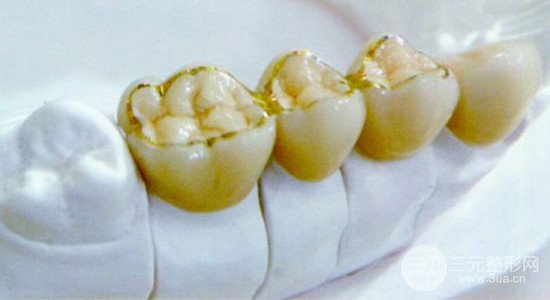 黄金烤瓷牙价格、大概多少钱一颗