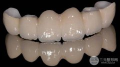 贵金属烤瓷牙的种类有哪些？有副作用吗？