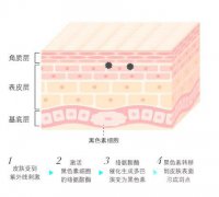 蝴蝶斑比较好缓解方法是什么？怎样基本消除？