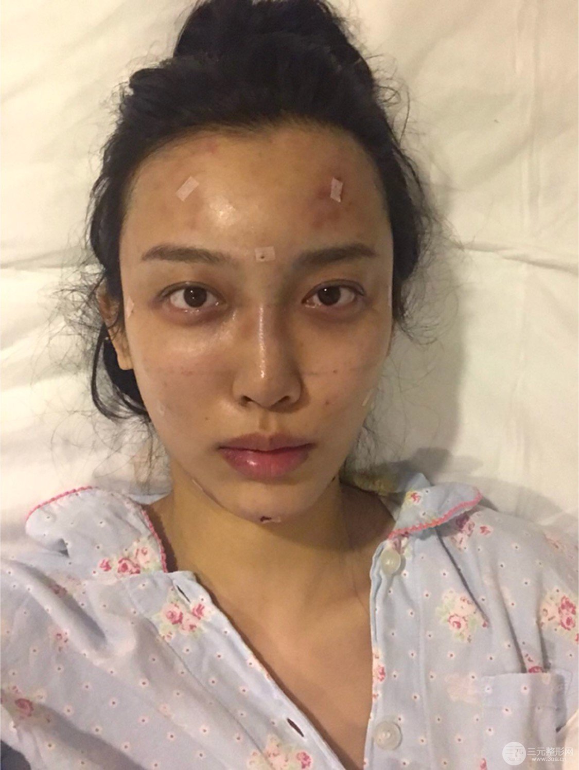 自体脂肪填充全脸三个月恢复效果图真实案例分享