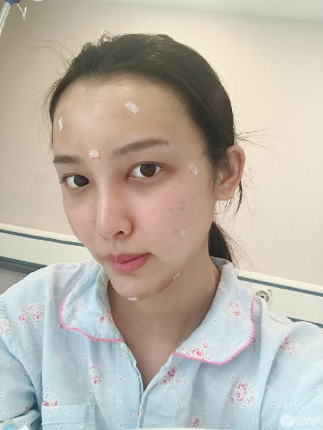 自体脂肪填充全脸三个月恢复效果图真实案例分享